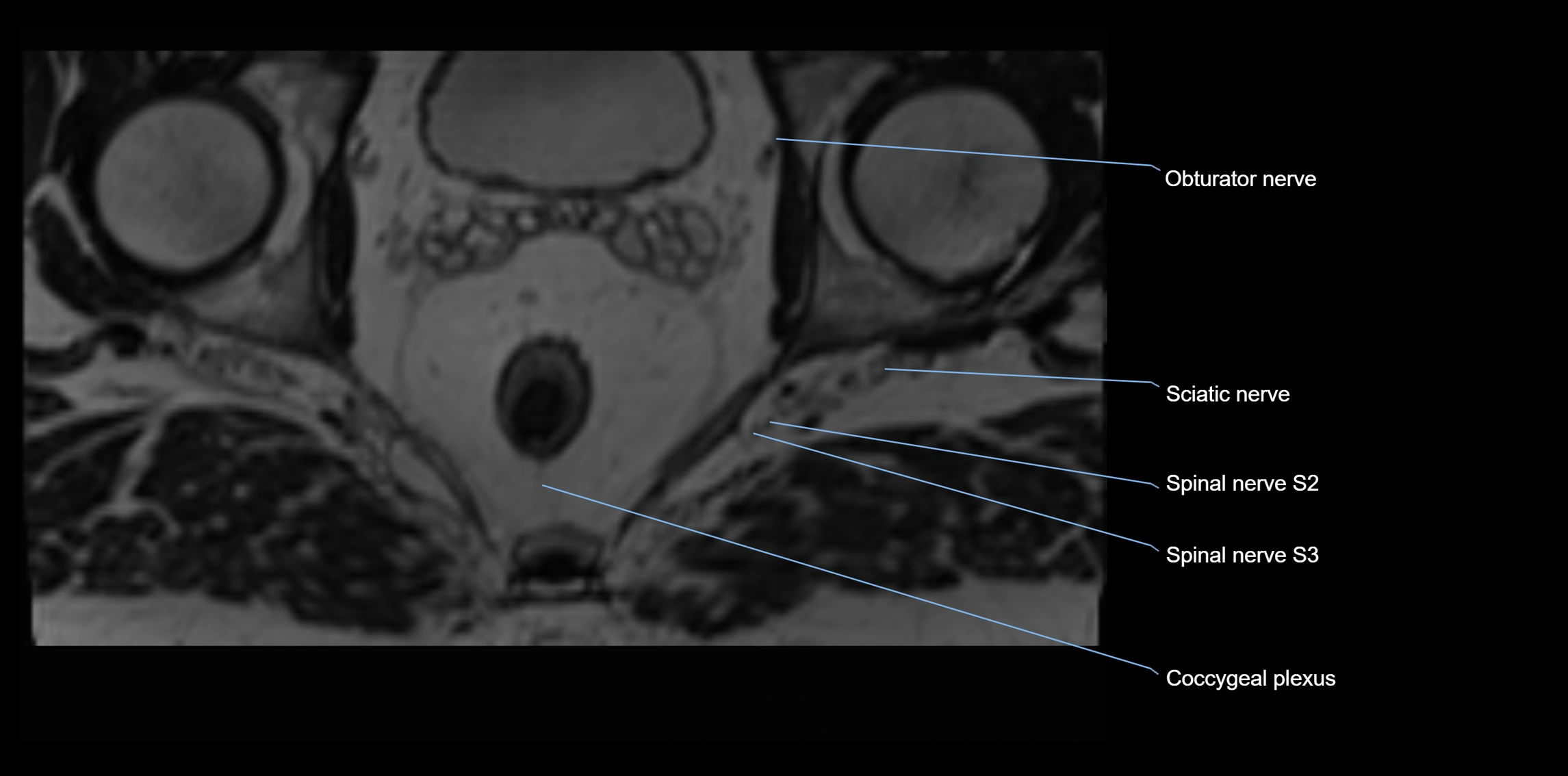 MR lumbosacral plexus axial cross sectional anatomy 3T  radiology  image-img-1008001-00118.webp